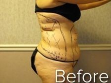 Side view of a person's torso marked with surgical lines.