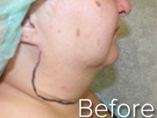 Neck of a person with surgical markings.
