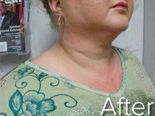 Woman's neck and jawline after a cosmetic procedure, with redness visible.