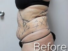 Side view of a torso marked with surgical lines before an abdominal procedure.