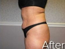 Side view of a torso in black lingerie, showing results after a body contouring procedure.