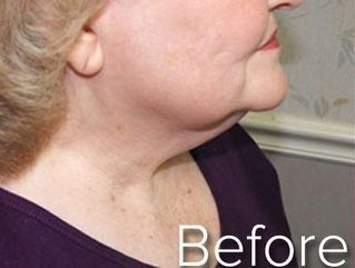 Side profile of a person before cosmetic neck procedure; shows a double chin.