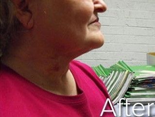 Side view of a person's neck after cosmetic treatment, showing improvement in skin appearance.