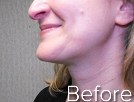 Profile view of a smiling face, showing neck wrinkles before a procedure.