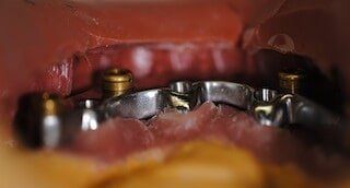 Overdentures — Newport News, VA - Tidewater Prostho