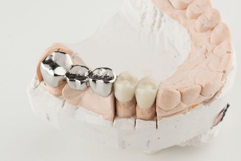 Bridged Dental Prostheses — Newport News, VA - Tidewater Prostho
