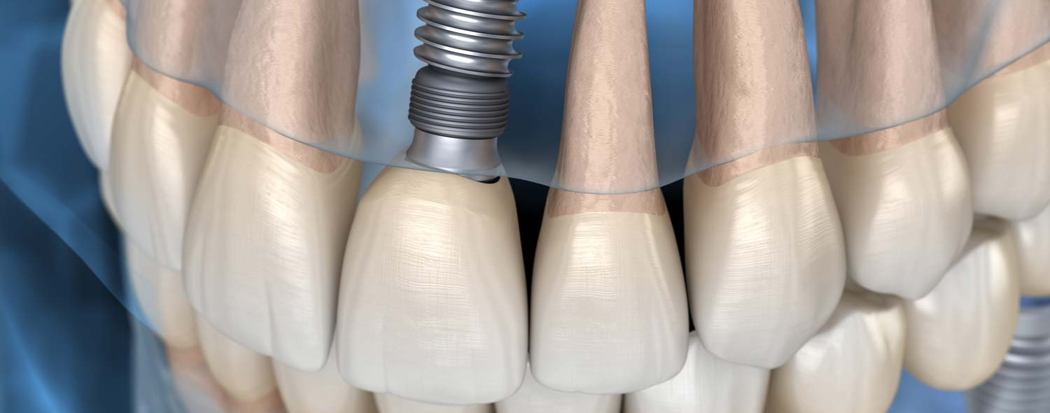 A close up of a person 's teeth with a dental implant in them.