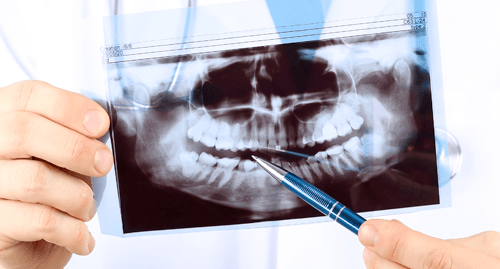A dentist is pointing at an x-ray of a person 's teeth.