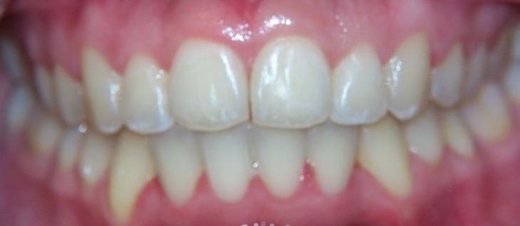 A close up of a person 's teeth with white teeth