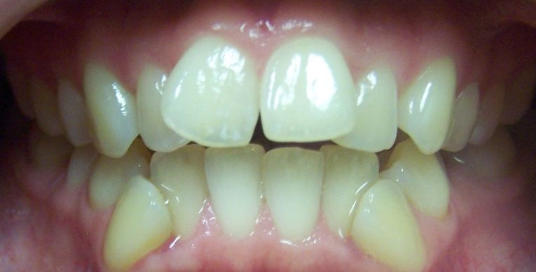 A close up of a person 's teeth and gums.