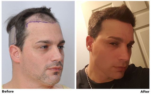 TOP HAIR TRANSPLANT RESULTS DEPEND ON *YOU* DURING RECOVERY!