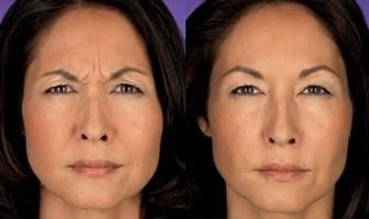 Who Is A Good Candidate for Botox?