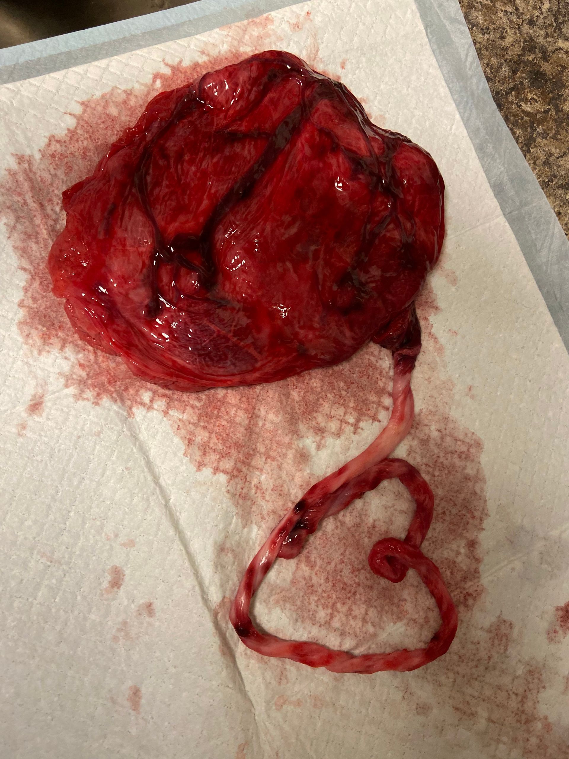 Placenta with umbilical cord in a heart shape on a white paper towel, stained with blood.