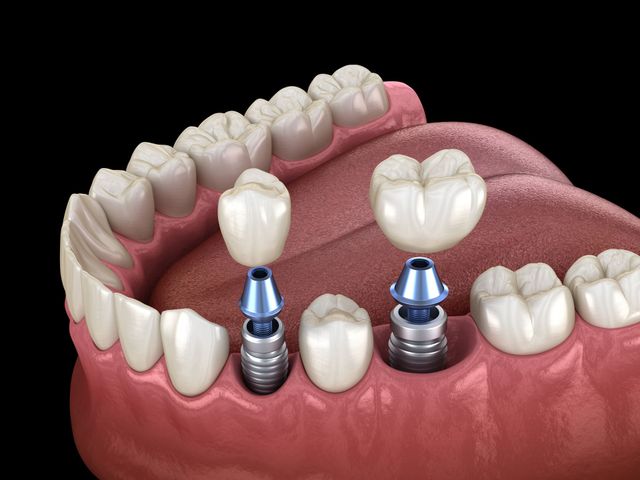 Tooth Implants – Bonita Springs, FL – Serenity Smiles