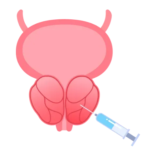 Illustration d’une prostatectomie assistée par robot chirurgical.