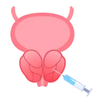 Illustration d’une prostatectomie assistée par robot chirurgical.