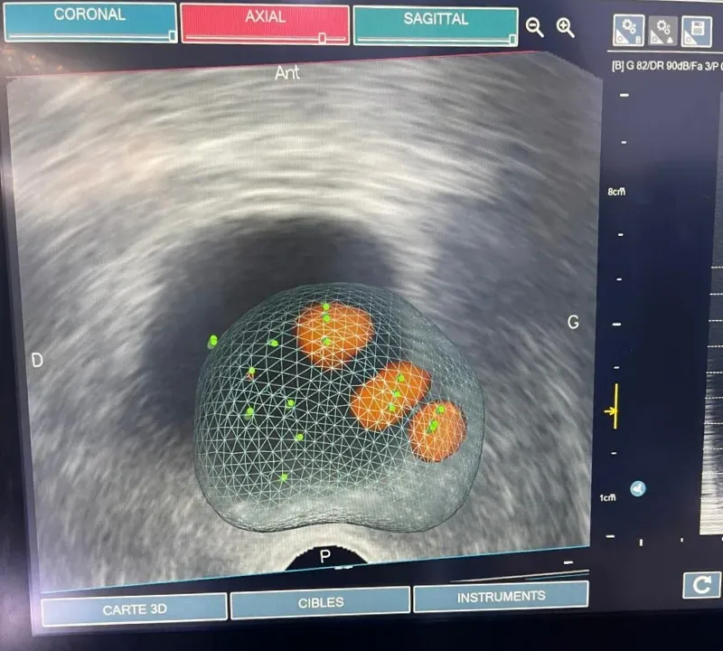 Image d’écran montrant une biopsie prostatique ciblée.