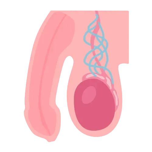 Illustration d’une cure de varicocèle réalisée sous microchirurgie.