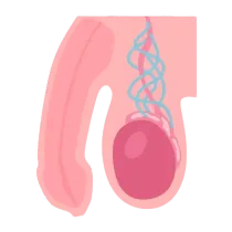 Illustration d’une cure de varicocèle réalisée sous microchirurgie.