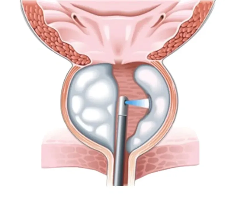 Illustration de l’énucléation de la prostate au laser.