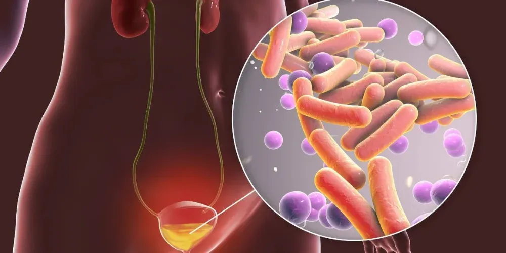 Diagnostic des infections urinaires