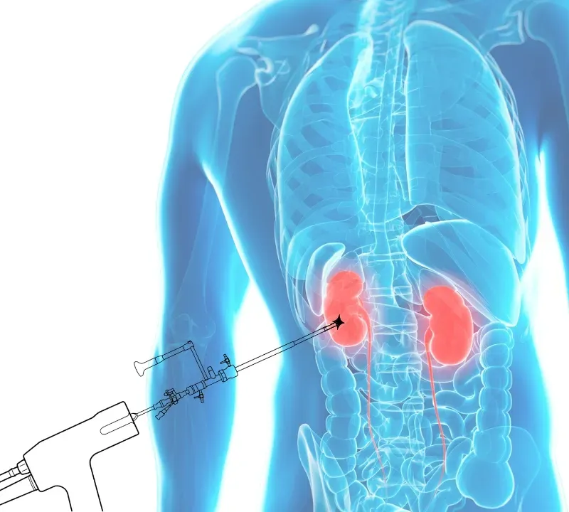 Illustration de la NLPC, néphrolithotomie percutanée pour traiter les calculs rénaux.