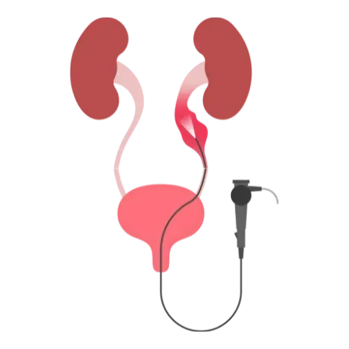 Illustration d’une urétéroscopie souple au laser pour traiter les calculs urinaires.