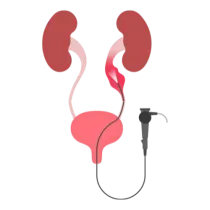 Illustration d’une urétéroscopie souple au laser pour traiter les calculs urinaires.
