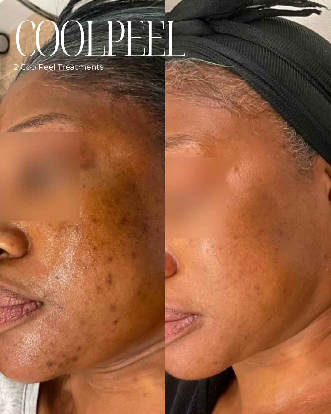 coolpeel laser for acne before and after.