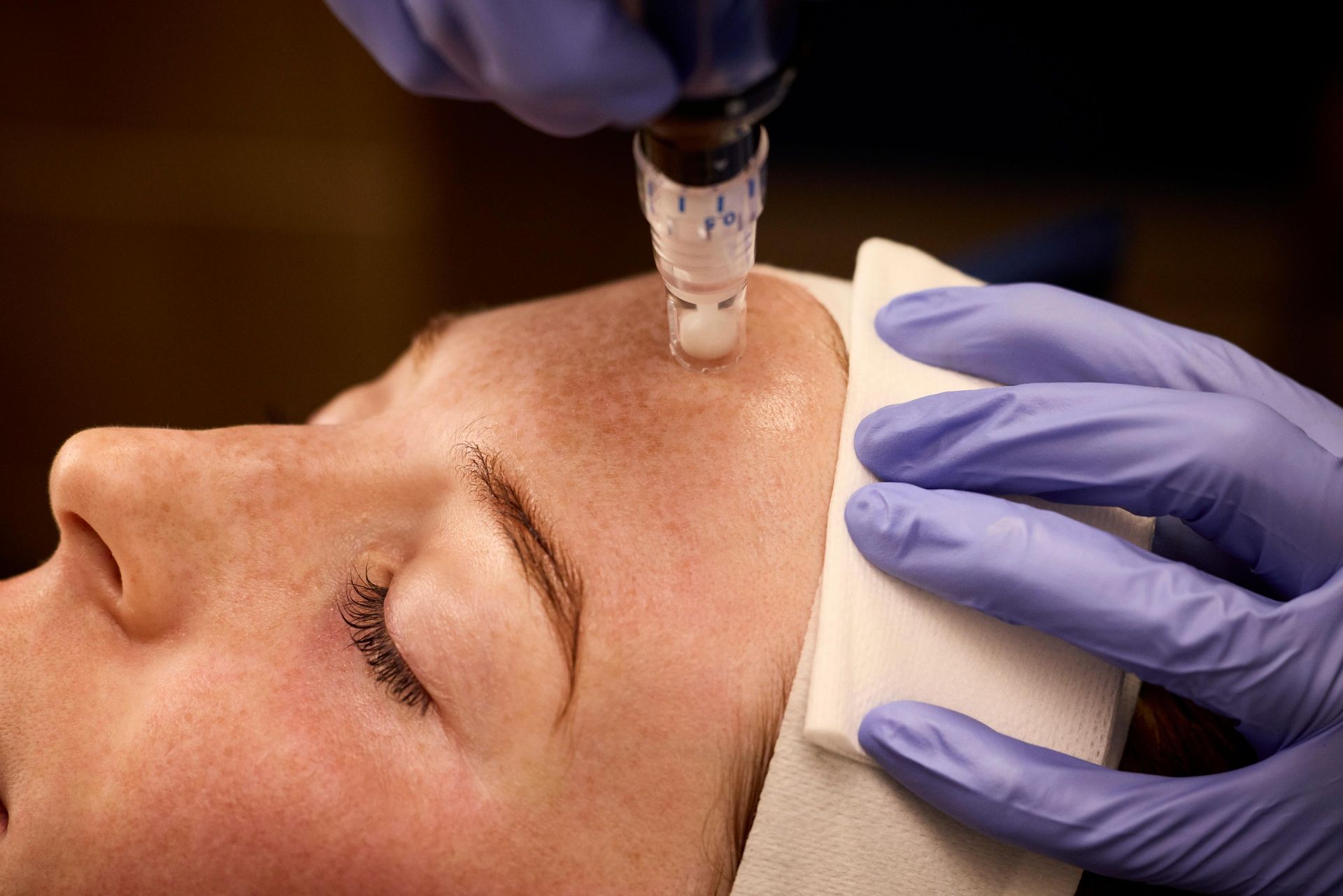 SkinPen microneedling treatment in progress at Clovis, New Mexico med spa