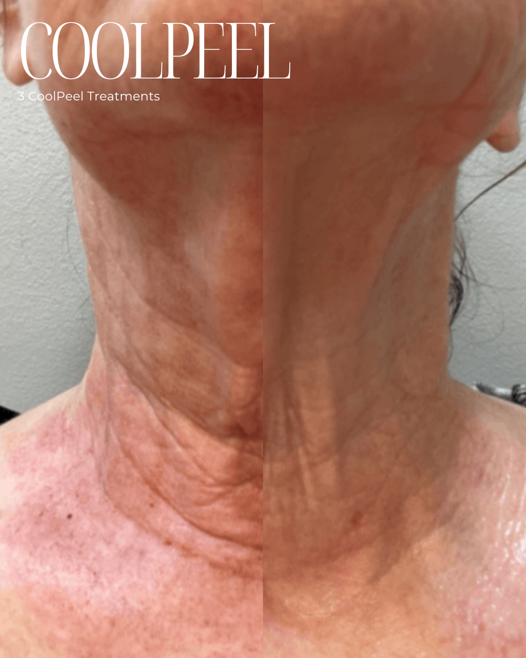 Before and after of a CoolPeel treatment on the neck