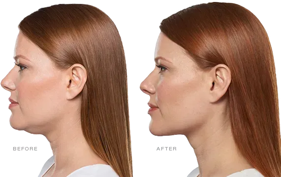 KYBELLA
