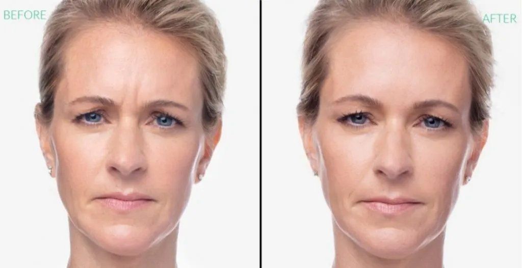 before and after