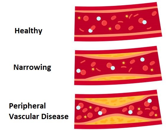 Peripheral Vascular Disease