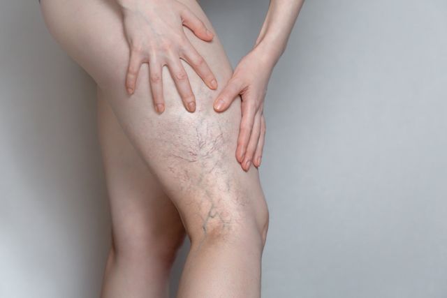 Spider Vein Sclerotherapy in Ormond Beach, FL