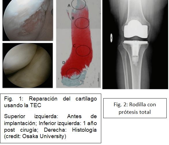 Una radiografía de una rodilla con una leyenda que dice rodilla con prótesis total.