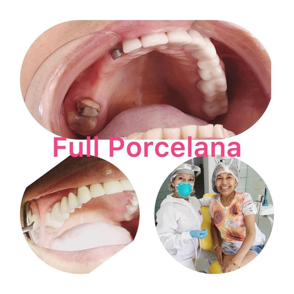 Una imagen de la boca de una persona con las palabras full porcelana en ella