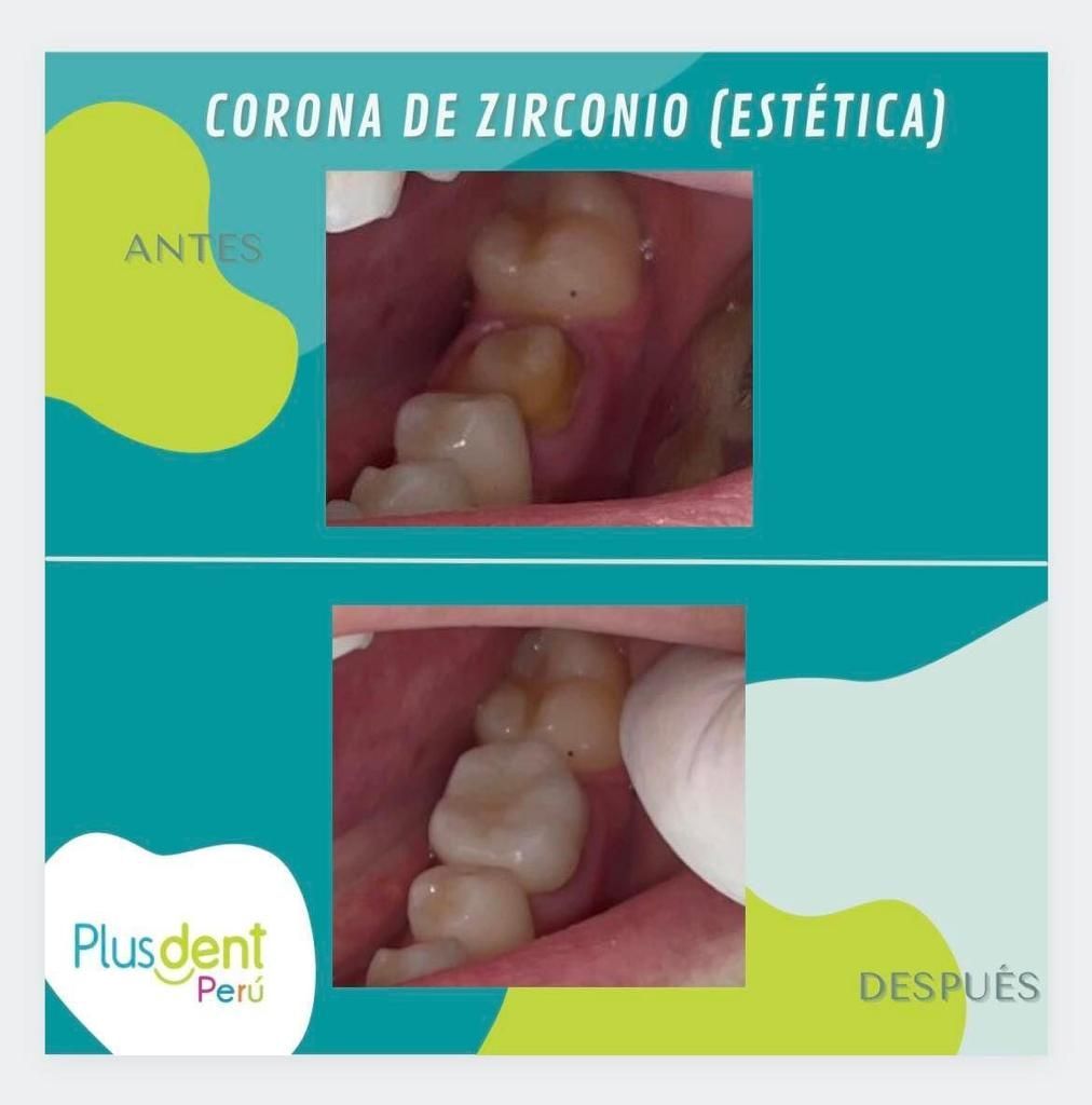 Una fotografía de antes y después de los dientes de una persona.