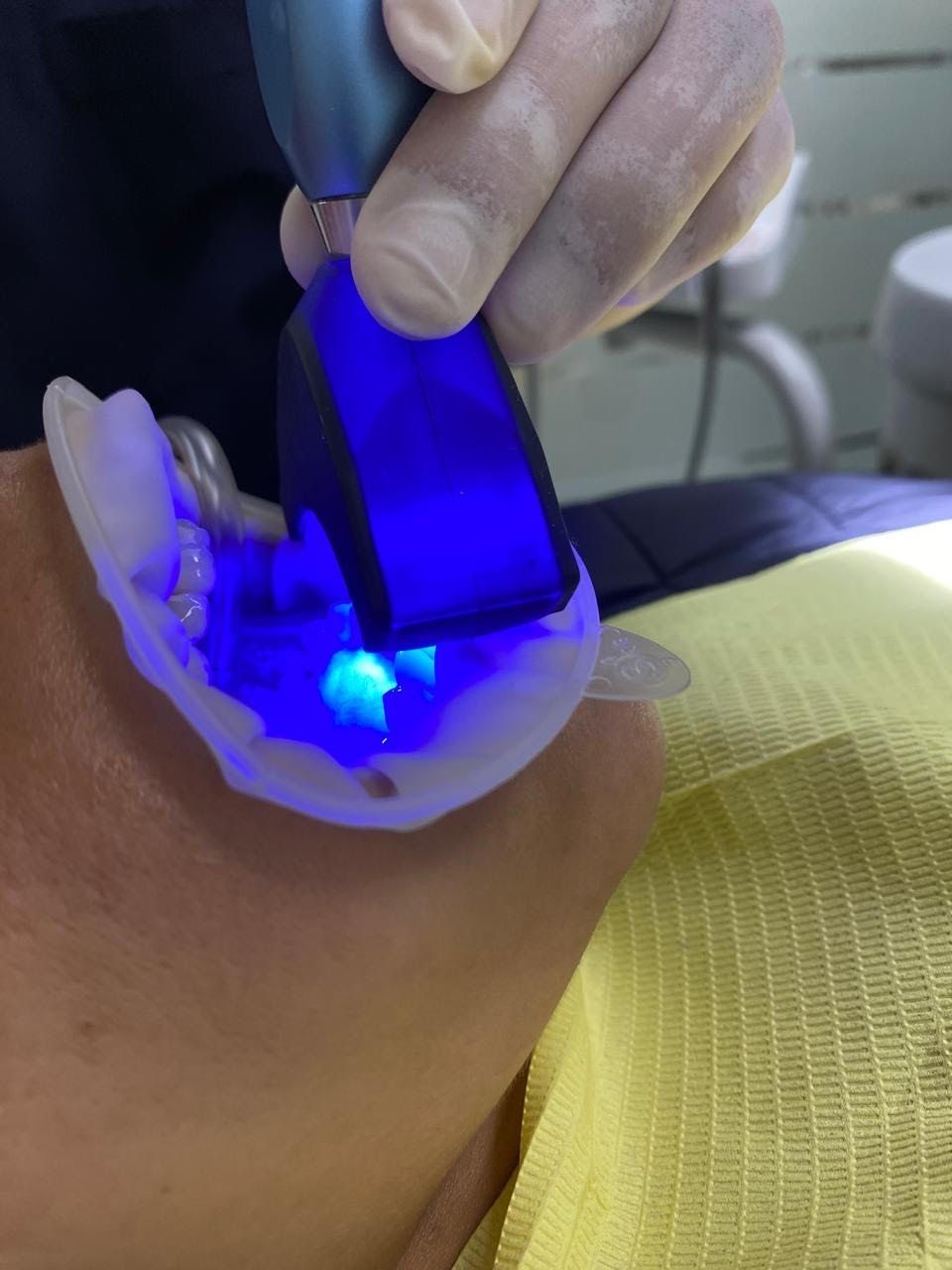 Un dentista utiliza una luz azul para blanquear los dientes de un paciente.