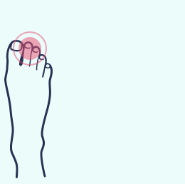 A drawing of a foot with a red spot on the toe.