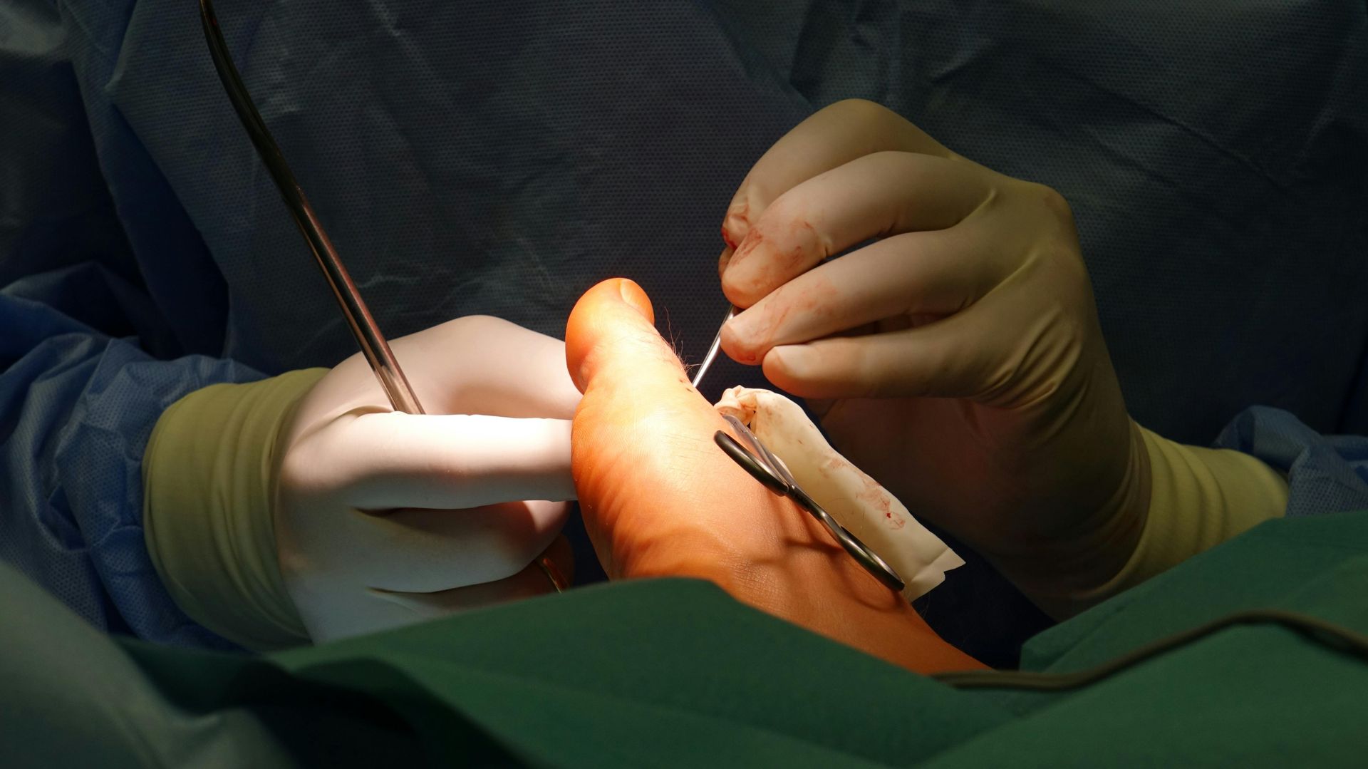 Plantar Fasciitis