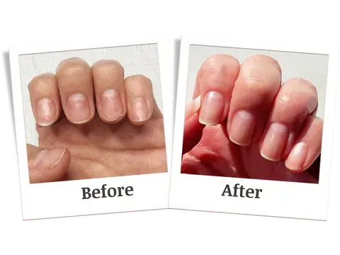 Before and after of fingernails; shows short nails growing longer and healthier.
