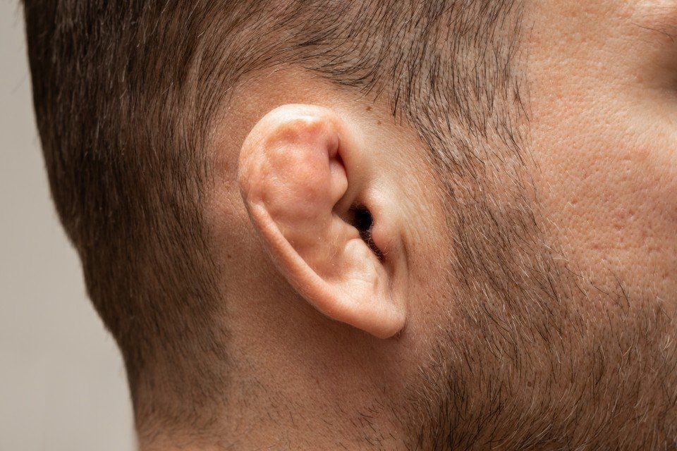 Malformazione orecchio