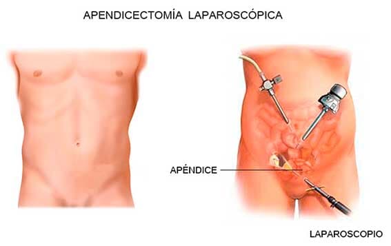 CLÍNICA WILLIAM R. PARMER - Cirugía de apéndice
