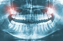 Panoramic dental X-ray showing upper and lower teeth and jawbones