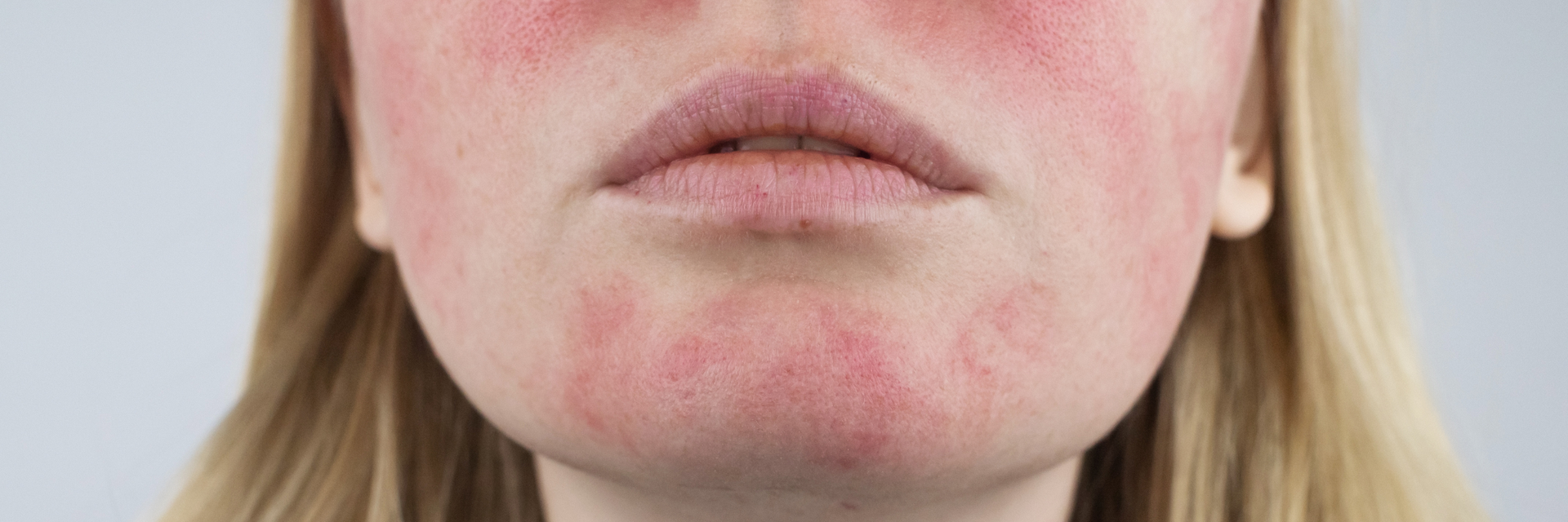 Face with rosacea