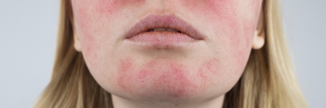 https://lirp.cdn-website.com/856948b6/dms3rep/multi/opt/face+with+rosacea-640w.png