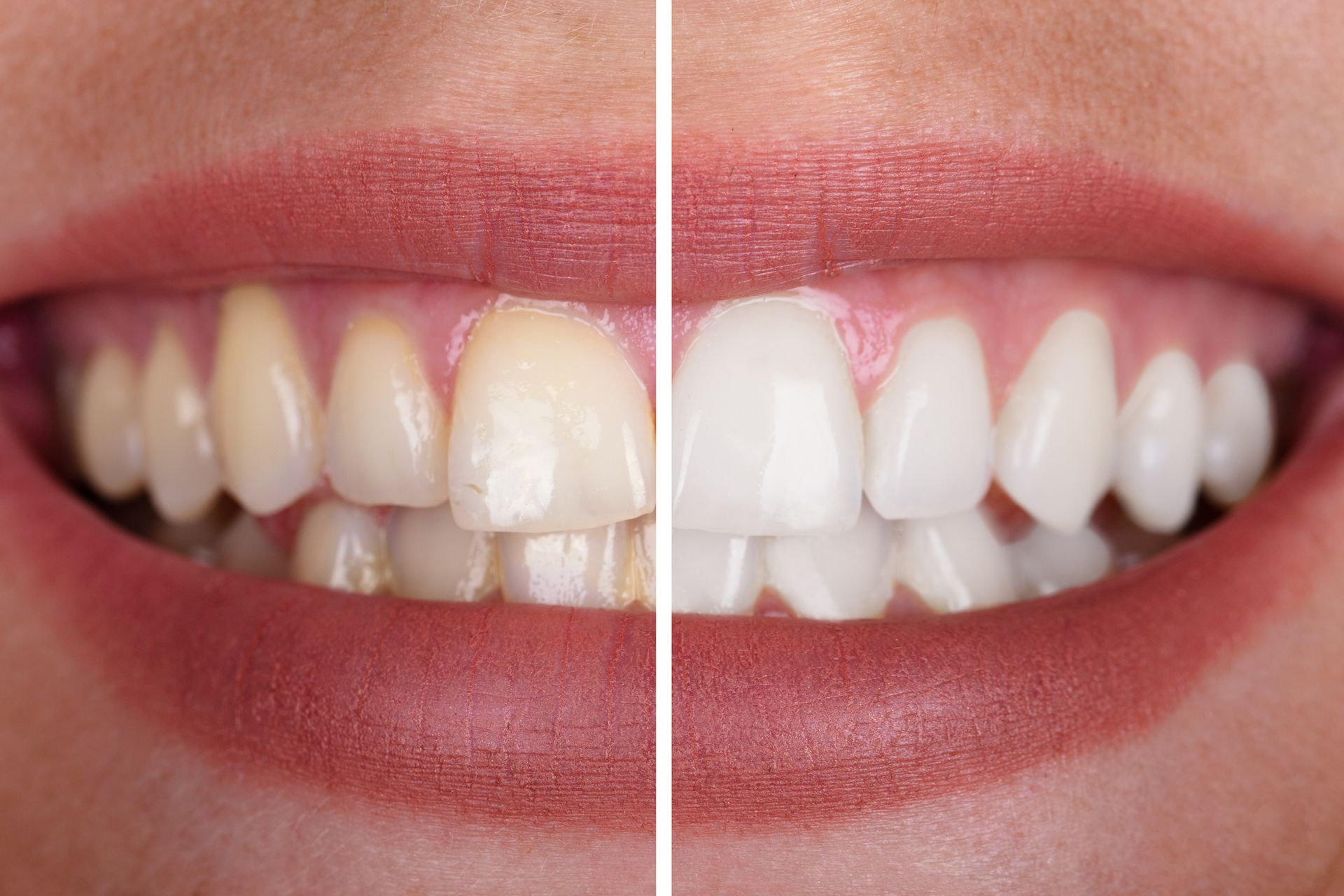 A before and after photo of a woman's teeth.