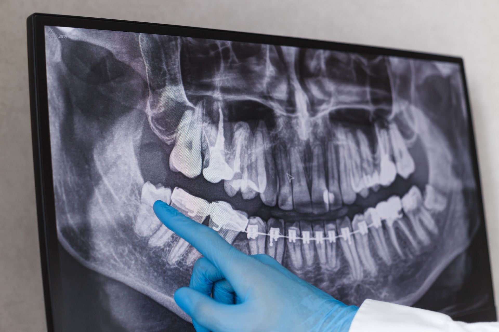 A dentist is pointing at an x-ray of a person's teeth.