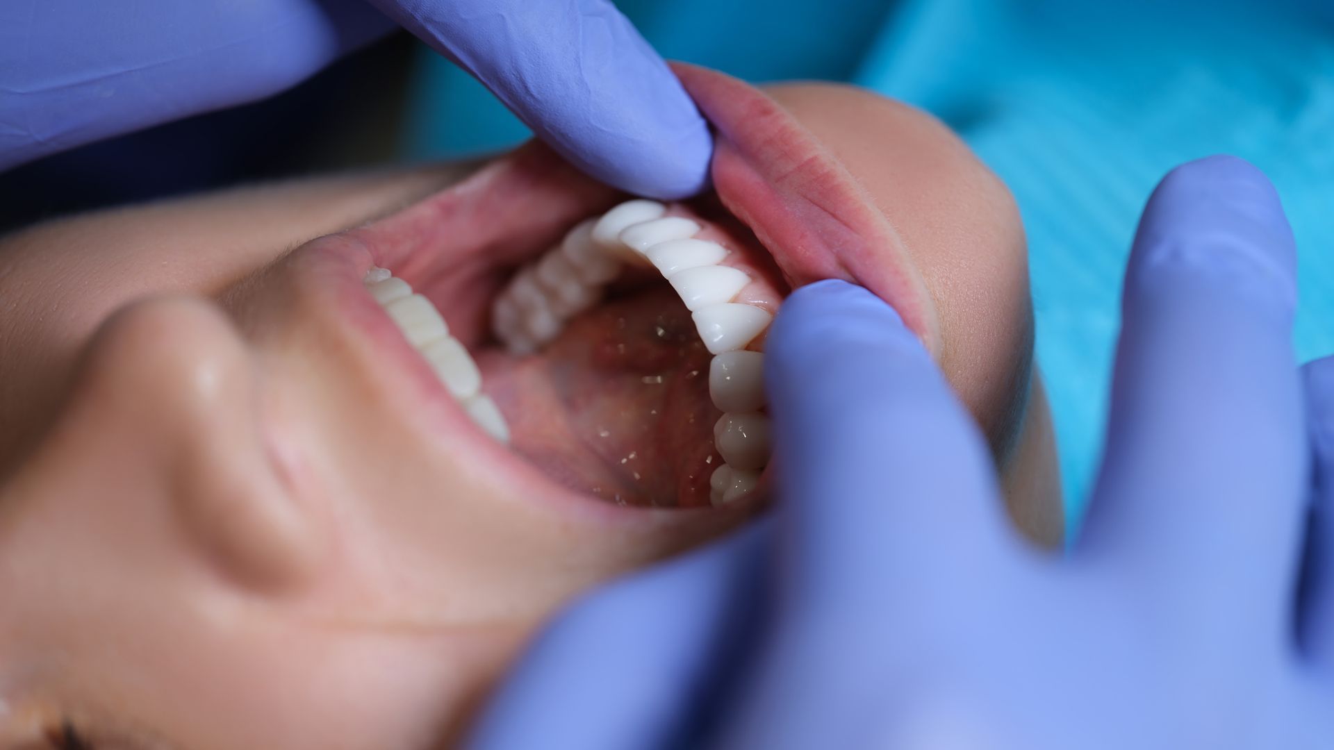 A woman is getting her teeth examined by a dentist.